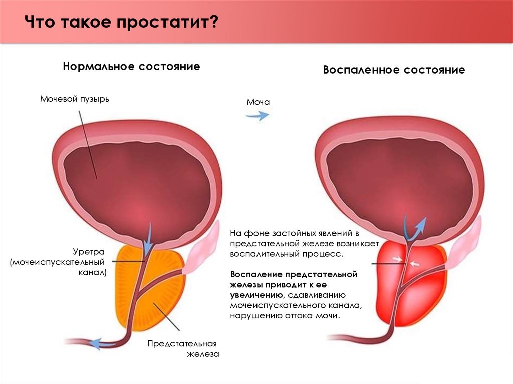 Признаками простатита являются